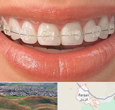ارتودنسی اقساطی در فارسان