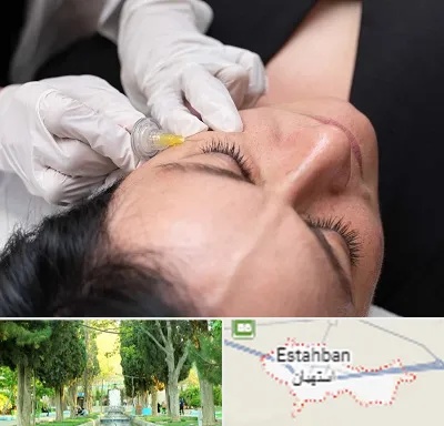کربوکسی تراپی در استهبان
