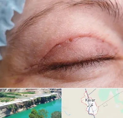 جراح پلک در کوار