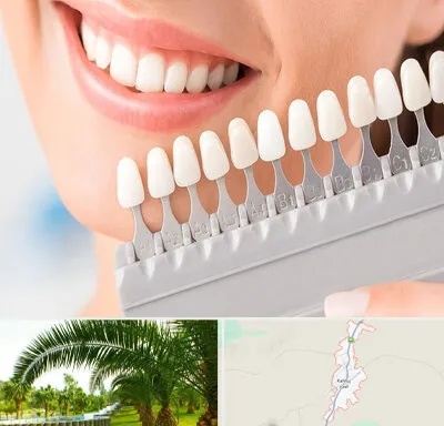متخصص لمینت دندان در کهنوج
