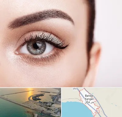 فوق تخصص عنبیه در بندر کنگان