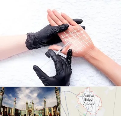 تزریق بوتاکس کف دست در آران و بیدگل