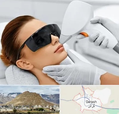 مرکز لیزر مو در گراش