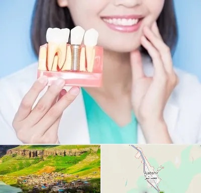 متخصص ایمپلنت در عجب شیر