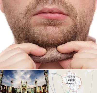ساکشن غبغب در آران و بیدگل