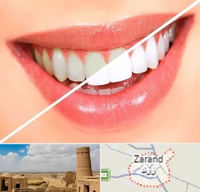 بلیچینگ دندان در زرند