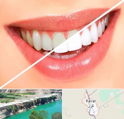 بلیچینگ دندان در کوار