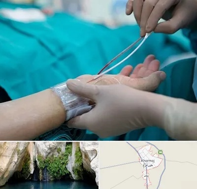 آنژیوگرافی در خورموج