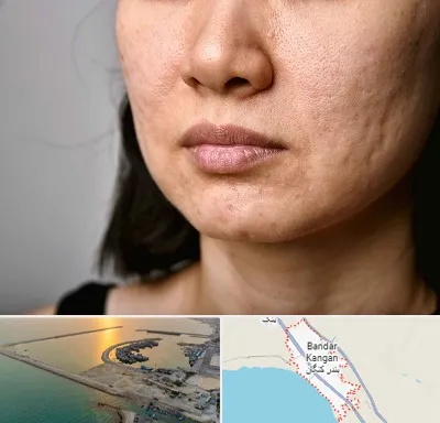 سابسیژن جای جوش در بندر کنگان