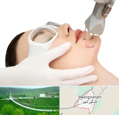 لیزر فرکشنال در مشگین شهر