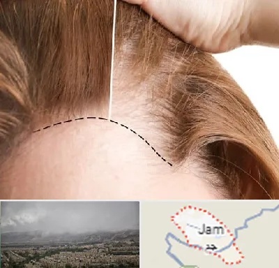 کاشت مو برای خانمها در جم