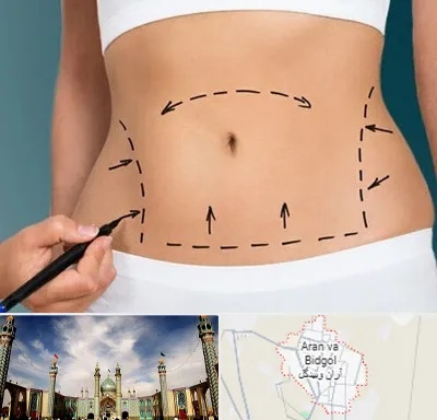 عمل ابدومینوپلاستی در آران و بیدگل