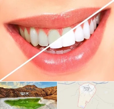 بلیچینگ دندان در گرمسار