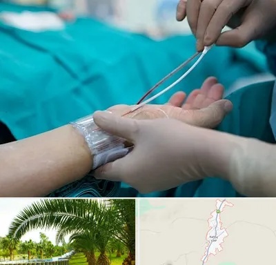 آنژیوگرافی در کهنوج