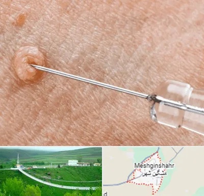 لیزر زگیل تناسلی در مشگین شهر