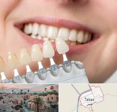 مرکز کامپوزیت دندان در طبس