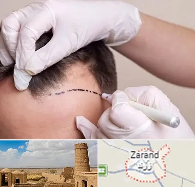 کاشت مو به روش SUT در زرند