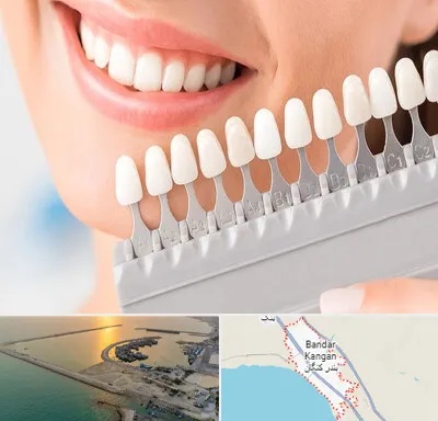 متخصص لمینت دندان در بندر کنگان