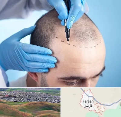 دکتر کاشت مو در فارسان