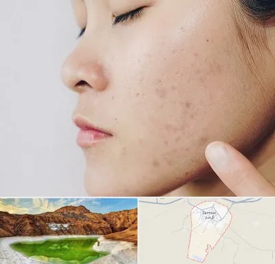 دکتر جوش صورت در گرمسار