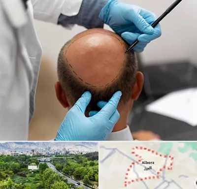 آموزش کاشت مو در البرز