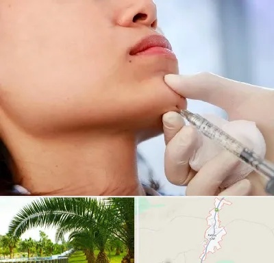 زاویه سازی صورت در کهنوج