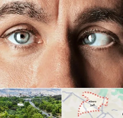 فوق تخصص استرابیسم در البرز