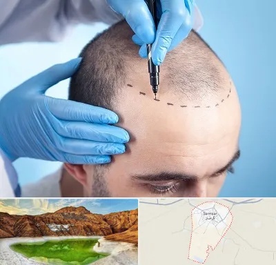 دکتر کاشت مو در گرمسار