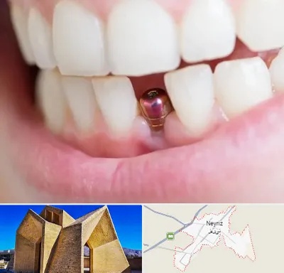 ایمپلنت اقساطی در نی ریز