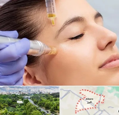 میکرونیدلینگ در البرز