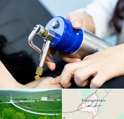 کرایوتراپی در مشگین شهر