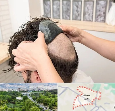 پروتز مو در البرز
