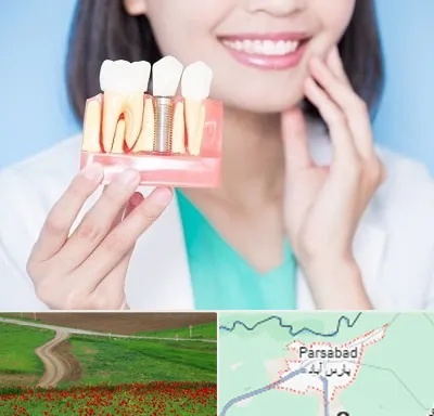 متخصص ایمپلنت در پارس آباد