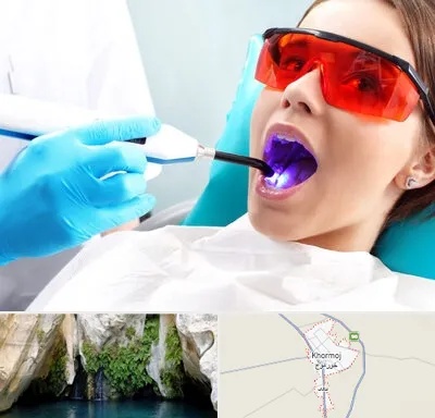 جراحی لثه با لیزر در خورموج