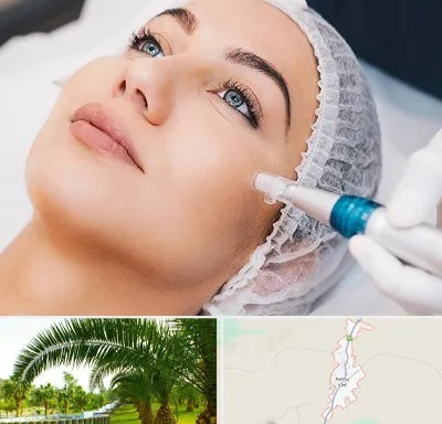 مزونیدلینگ در کهنوج
