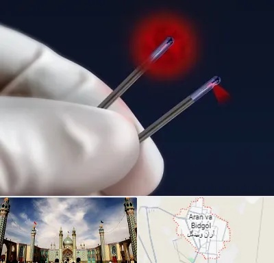 جراحی سینه با لیزر در آران و بیدگل