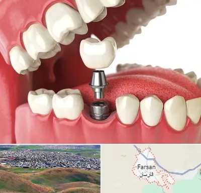 متخصص پروتز دندان در فارسان