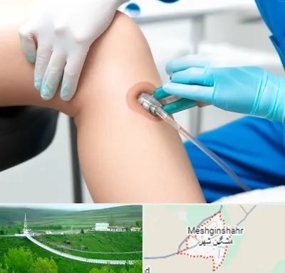 اوزون تراپی در مشگین شهر