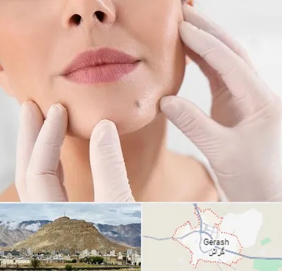 برداشتن خال در گراش