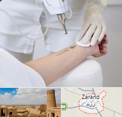 پاک کردن تتو با لیزر در زرند