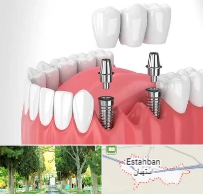 کاشت دندان در استهبان