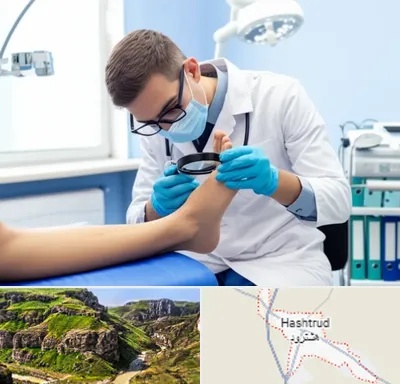 درمان زخم پای دیابتی در هشترود