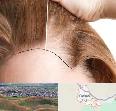 کاشت مو برای خانمها در فارسان