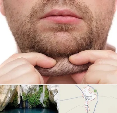 ساکشن غبغب در خورموج