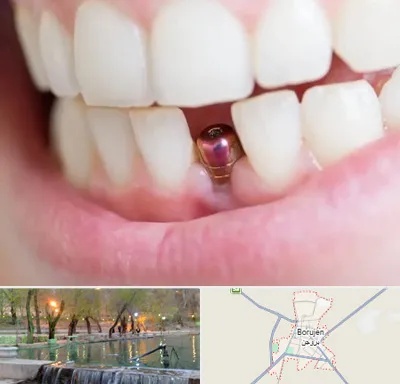 ایمپلنت اقساطی در بروجن