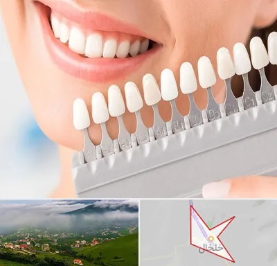 متخصص لمینت دندان در خلخال