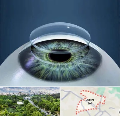 پیوند قرنیه در البرز
