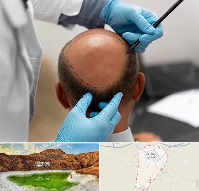 آموزش کاشت مو در گرمسار