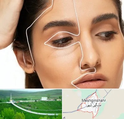عمل بینی اقساطی در مشگین شهر