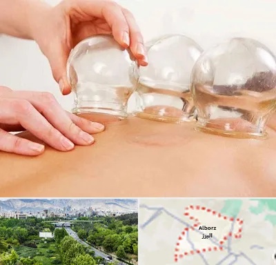 بادکش درمانی در البرز